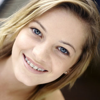 Clear Braces